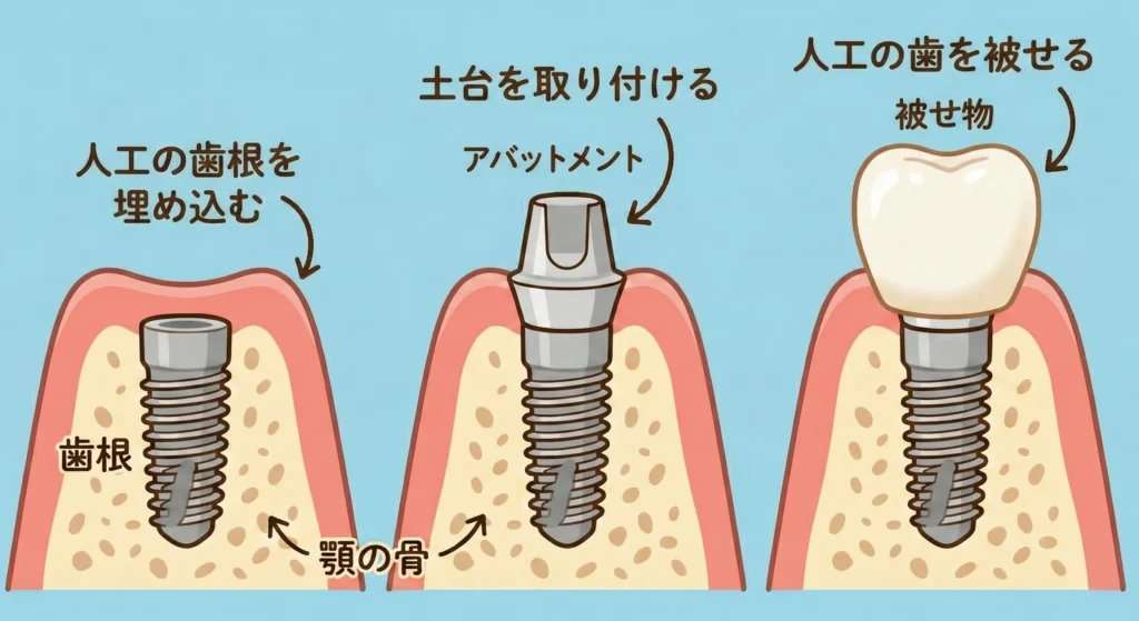 インプラント治療とは