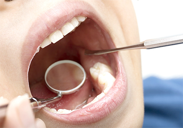 歯科施術のイメージ