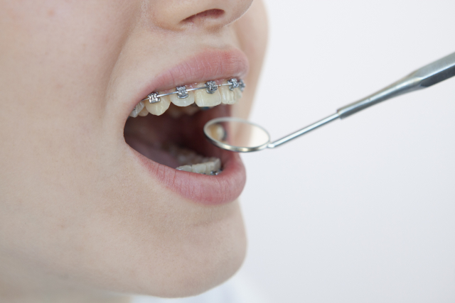 歯列矯正中にホワイトニングをすることは可能？