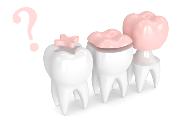 歯の被せ物イメージ