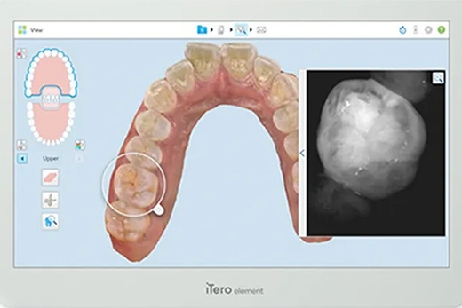 こせき矯正歯科の口腔内3Dスキャナー